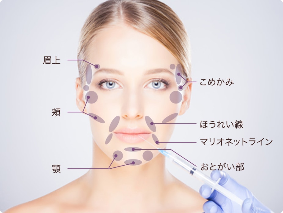 ヒアルロン酸注入部位
